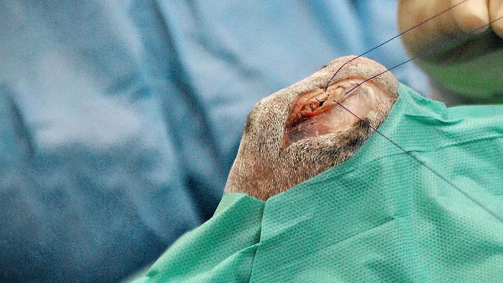 Nahaufnahme eines zahnchirurgischen Eingriffs mit Darstellung von Instrumenten und Nähten, die um einen freiliegenden Zahn auf einem blauen sterilen Abdecktuch angewendet werden.